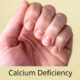 कैल्शियम की कमी के लक्षण